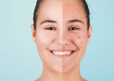 Acne & Scar Management